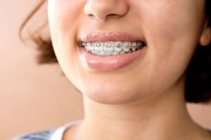 Woman with braces smiling