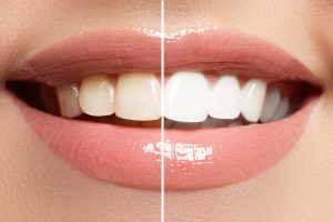 We Answer Your Questions about Teeth Whitening