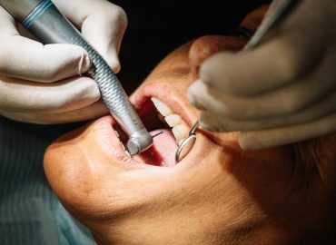 Tooth Scaling