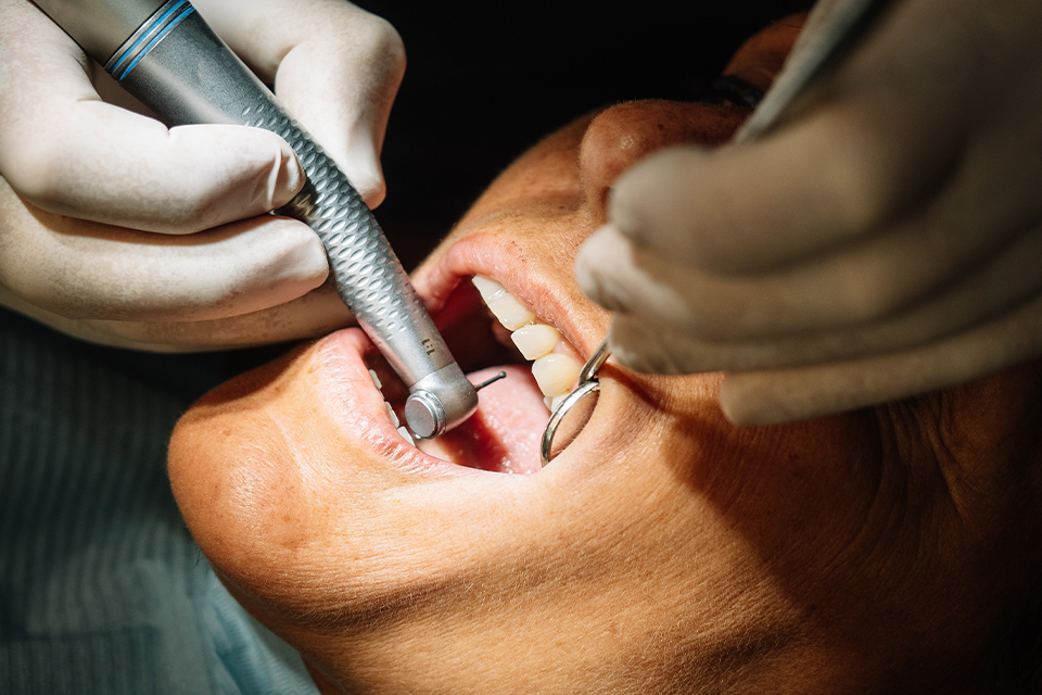 Tooth Scaling