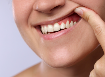 How to Stop Receding Gums From Getting Worse